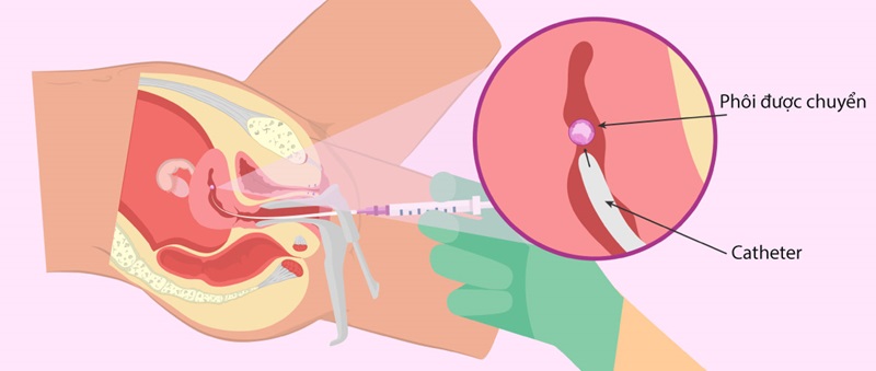 Theo dõi sức khỏe định kỳ sau chuyển phôi